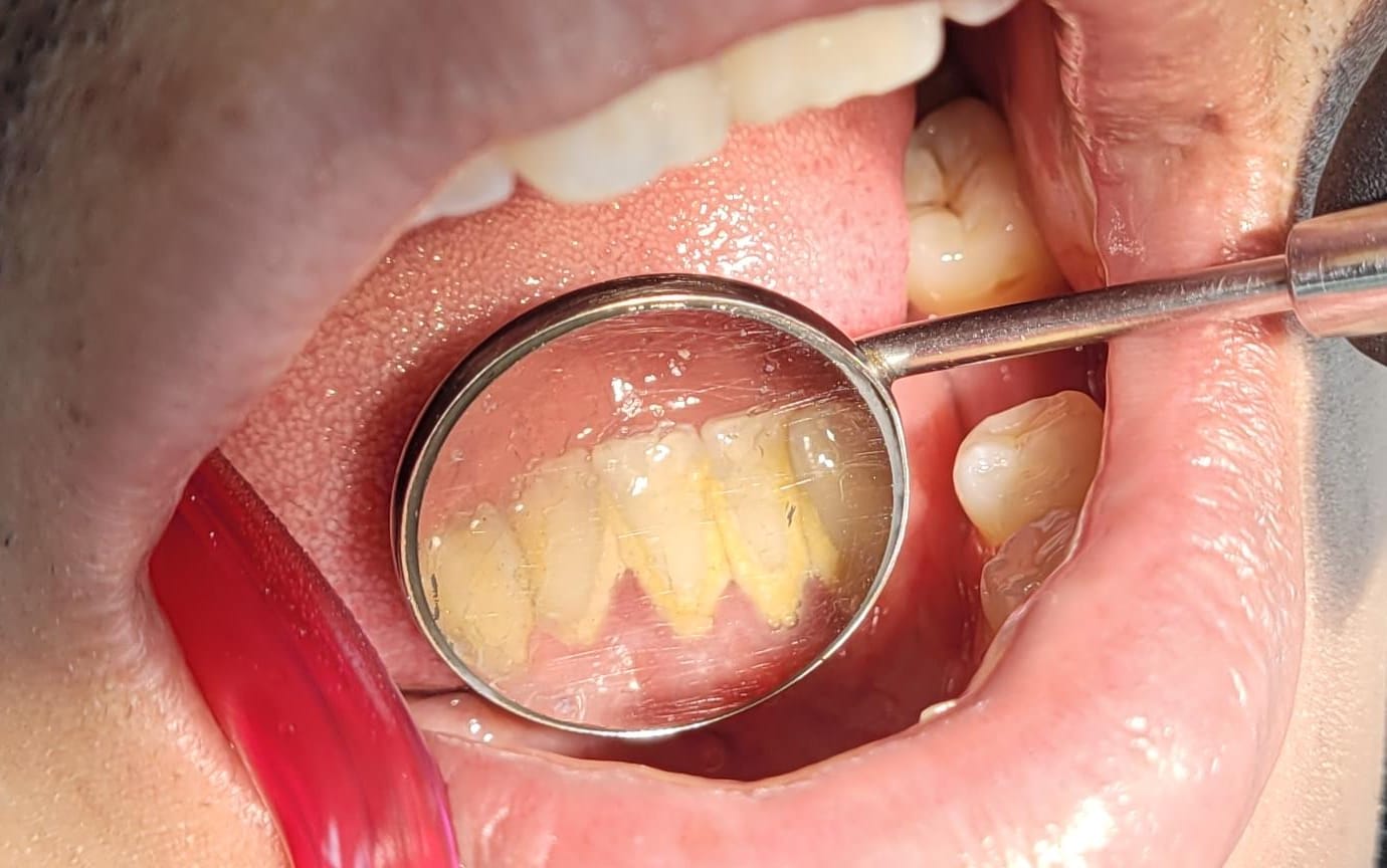 Acúmulo de cálculo dental antes de la limpieza
