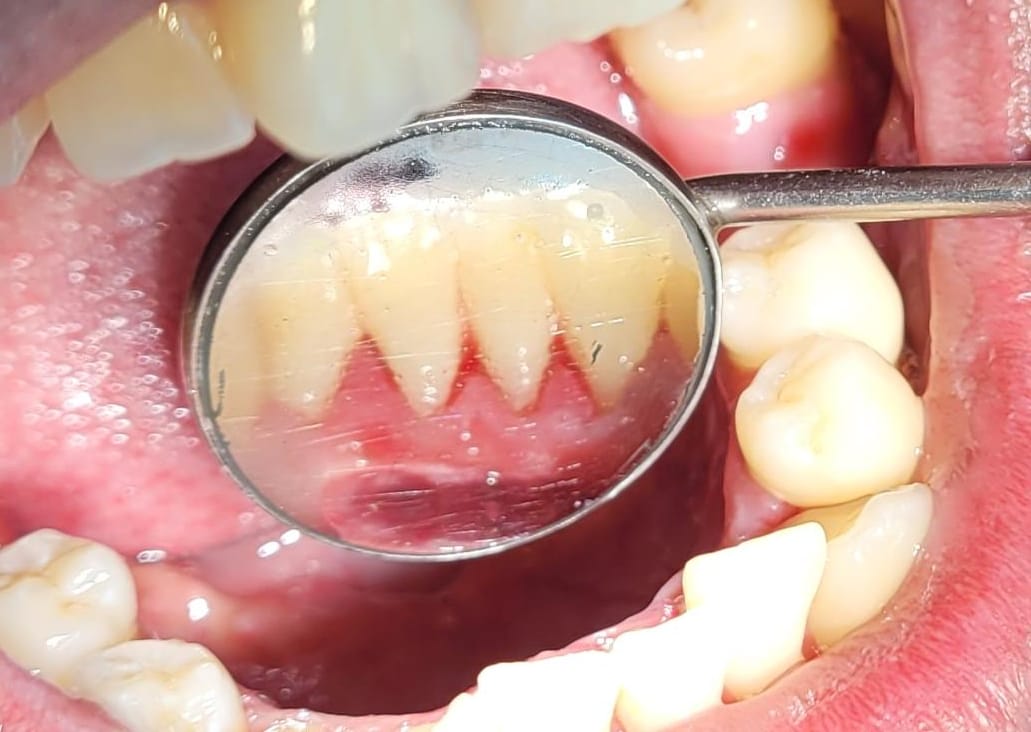 Encía y dientes tras la limpieza (sin cálculo)