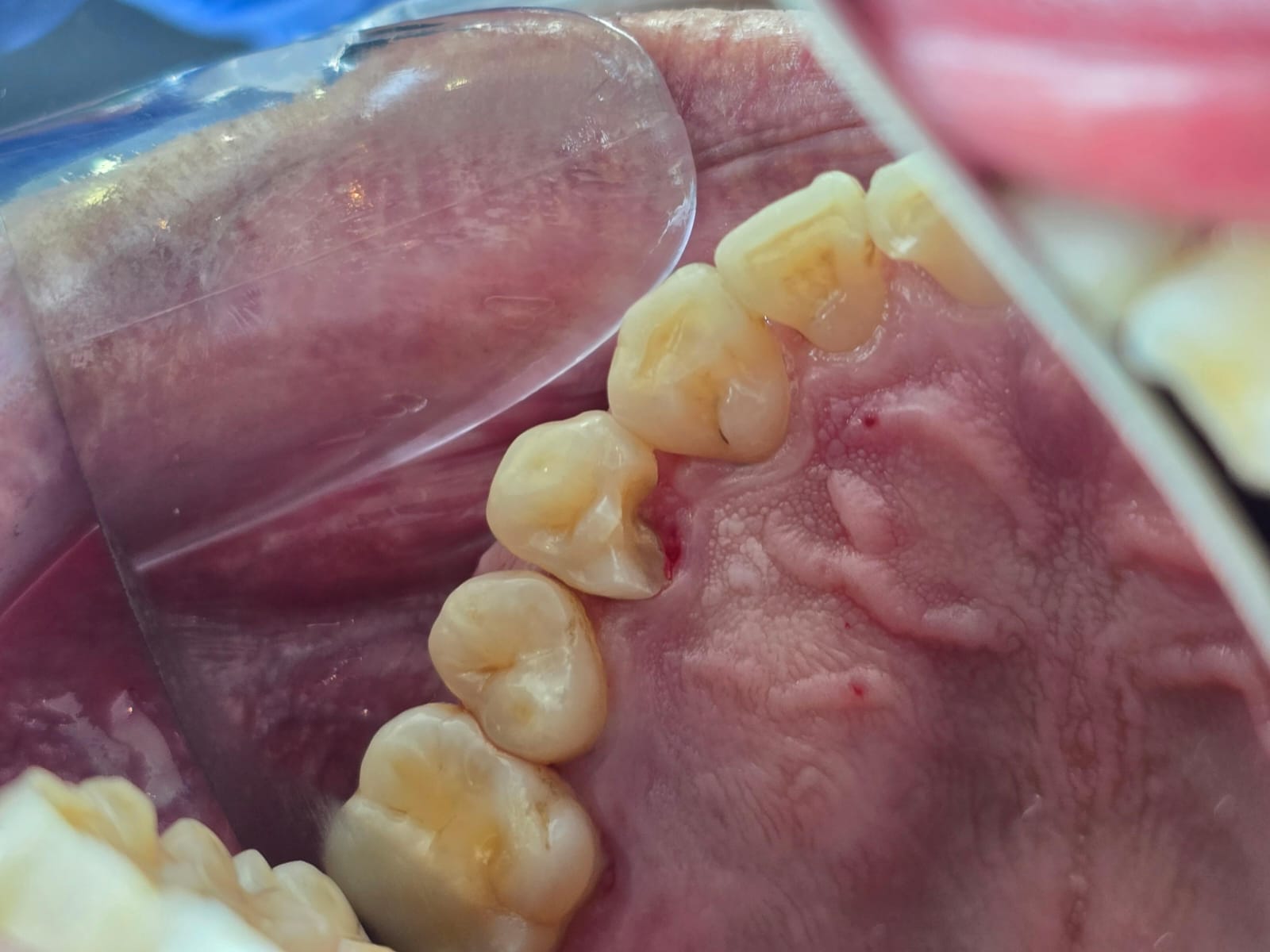 Otro caso: cálculo dental antes de la limpieza