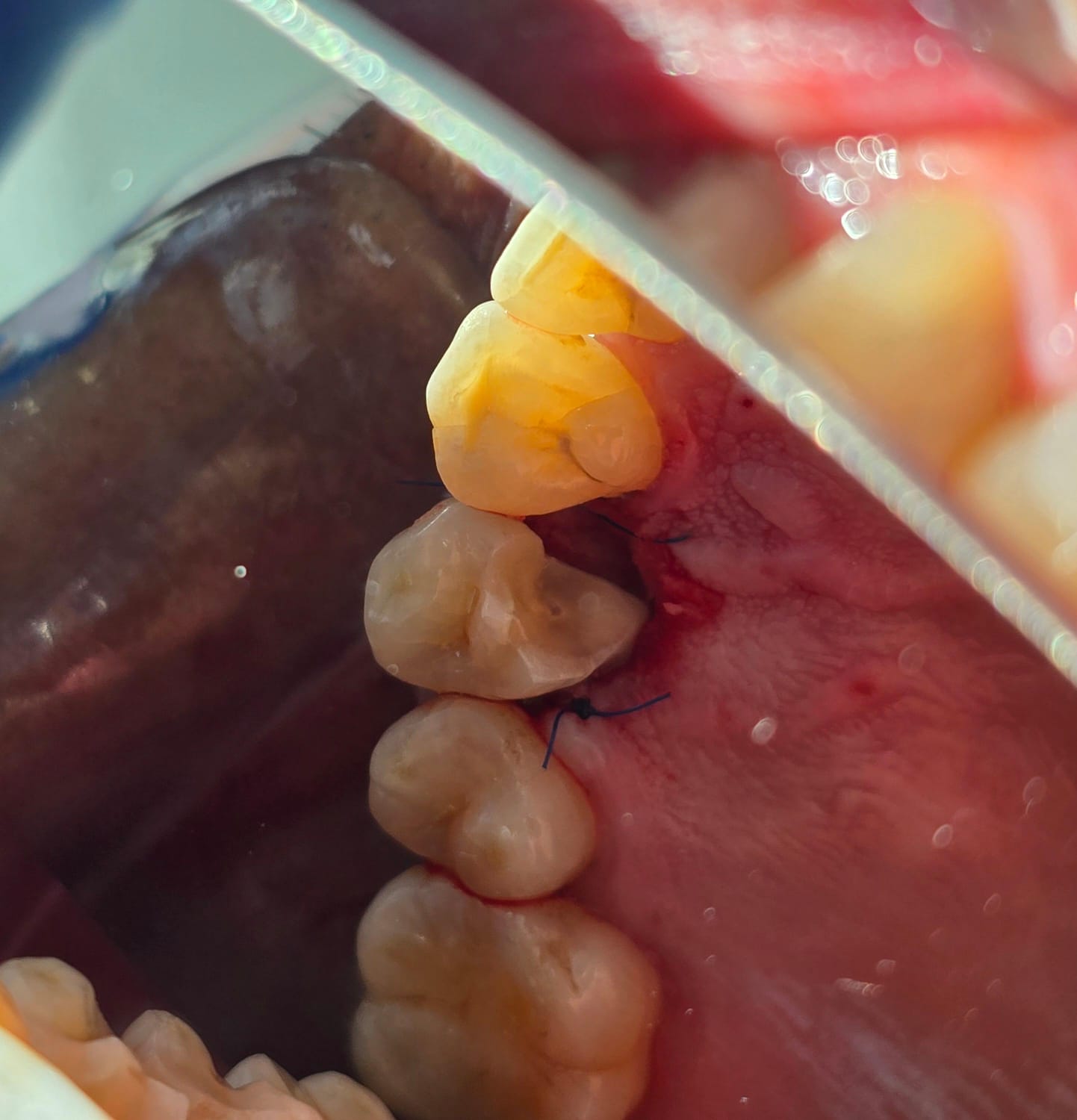 Otro caso: después de la limpieza, encía más sana