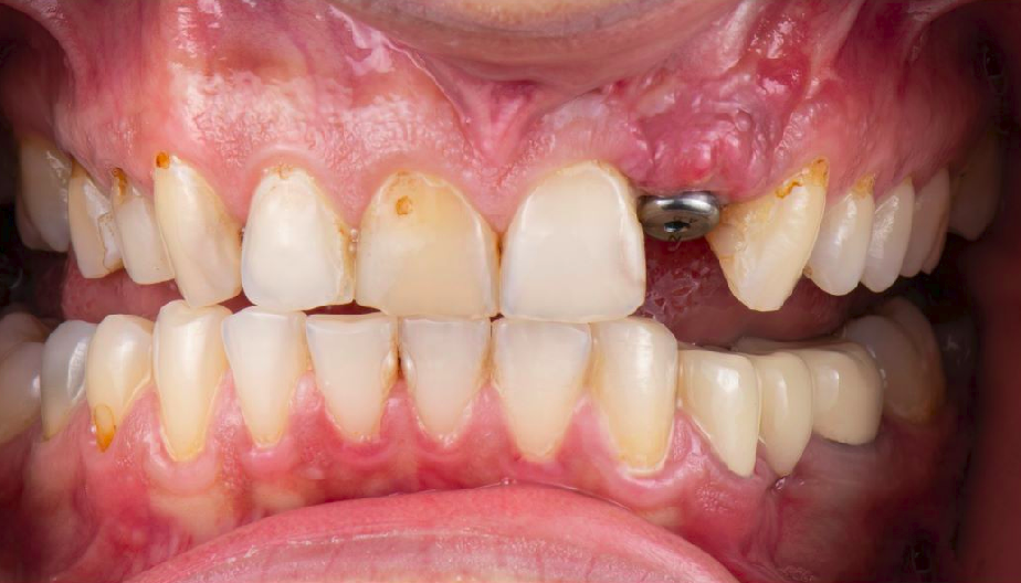Caso 3: cálculo dental antes de la limpieza