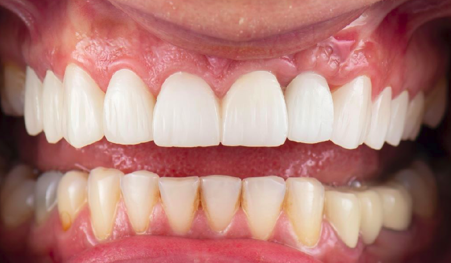 Caso 3: después de la limpieza, encía más sana