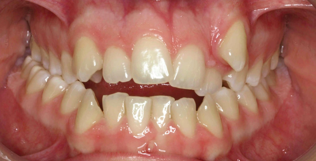 Caso 4: cálculo dental antes de la limpieza