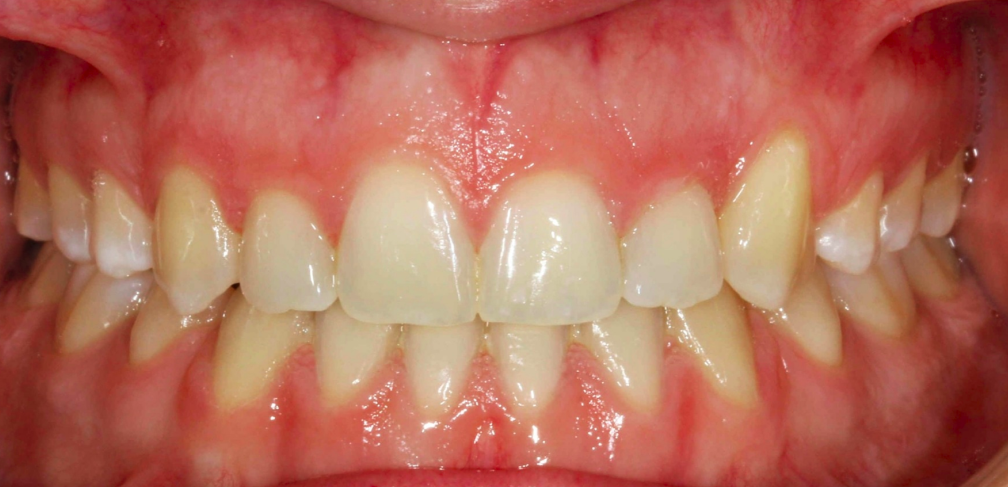 Caso 4: después de la limpieza, encía más sana