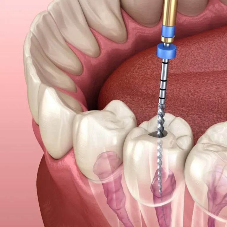 Endodoncia: qué es y cuándo se necesita